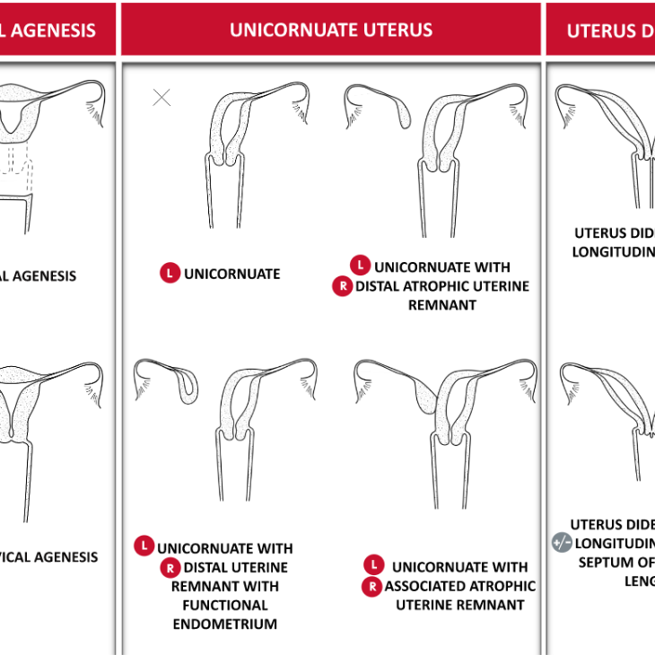 ASRM MÜLLERIAN ANOMALIES CLASSIFICATION 2021