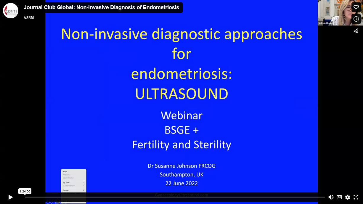 JOURNAL CLUB GLOBAL: NON-INVASIVE DIAGNOSIS OF ENDOMETRIOSIS teaser