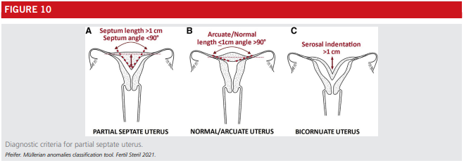 Fig10-asrm-mullerian-anomalies.png