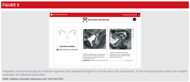 Fig9-asrm-mullerian-anomalies.png